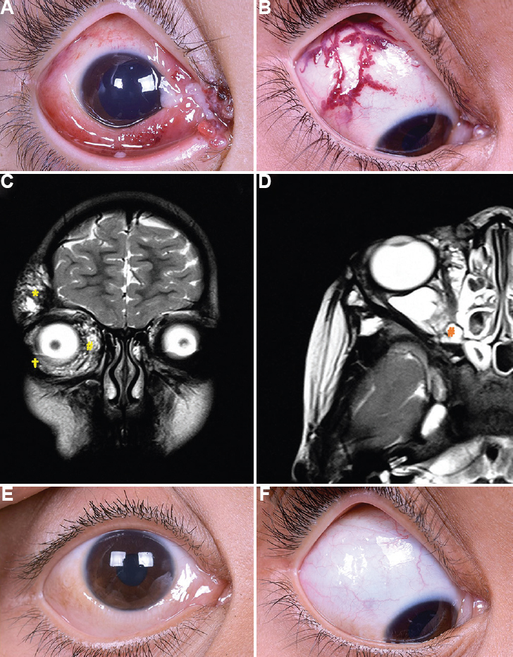 Presenting features, imaging findings and post sclerotherotherapy images of a lymphatico-venous malformation. (A) Mild proptosis, multinodular peripunctal lesion, chemosis and diffuse sub-conjunctival haemorrhage inferiorly. (B) Dilated tortuous and branching vessels in the superotemporal quadrant. (C) Ill-defined hyperintense lesions in the right temple (*), cheek (†) and orbit (#). (D) Antero-posterior extent is from the preseptal region to the orbital apex (#). (E) Decrease of orbital disease and eyelid disease. (F) Complete resolution of the conjunctival component.